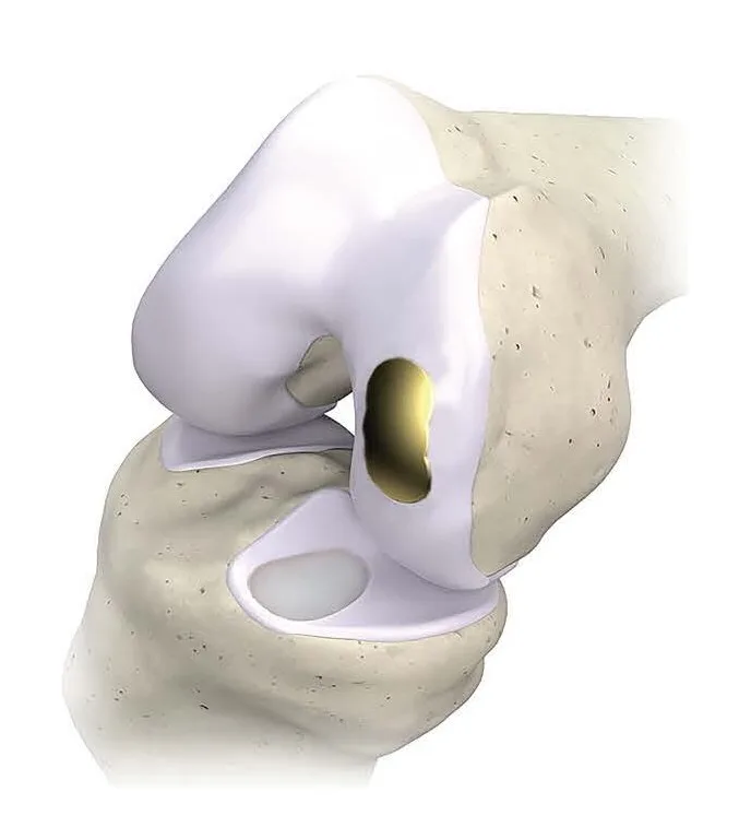 Overture’s titanium implant sees rising use in patients too young for total knee replacement