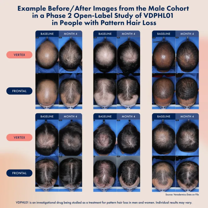 Will Veradermics’ non-hormonal oral pill become the first FDA-approved hair loss therapy in decades?