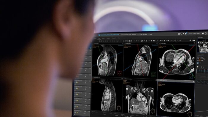 Philips bets on AI automation to solve cardiac MR access and staffing gaps