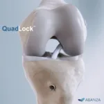 Abanza secures 510(k) for QuadLock ACL system with 500% reduction in displacement