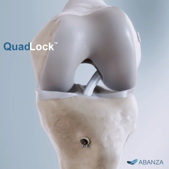 Abanza gains 510(k) for QuadLock ACL system: But is this a clinical leap or an engineering refinement?