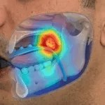 Stanford adopts Kallisio’s Stentra to improve reproducibility in IMRT for head and neck patients