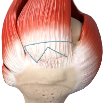 Smith+Nephew to acquire Integrity Orthopaedics to strengthen rotator cuff repair portfolio.