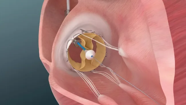 Trisol’s valve trial shows strong early outcomes in patients deemed too high risk for surgery