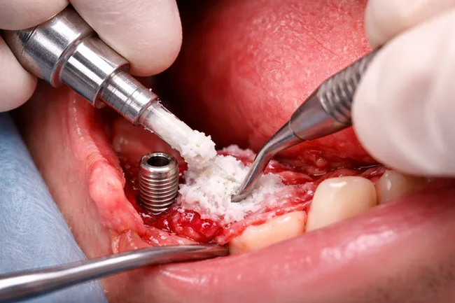 RevBio wins FDA nod to begin dental trial of TETRANITE bone adhesive