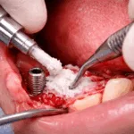 Representative image of a dental ridge augmentation procedure, reflecting the type of implant workflow RevBio’s TETRANITE bone glue aims to simplify by reducing reliance on membranes, meshes, and fixation screws.