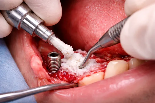 Is dental bone glue the new frontier in graft-free implantology? What RevBio’s TETRANITE trial could mean for chairside workflows