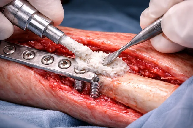 From orthopedic cement to smart scaffolds: Is the next generation of bone adhesives finally viable in human use?