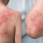 Representative image showing moderate to severe atopic dermatitis symptoms on the back and elbow, published in context of Johnson & Johnson’s discontinued Phase 2b trial of JNJ-5939 due to insufficient efficacy.