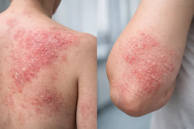 J&J ends JNJ-5939 trial early in atopic dermatitis after missing efficacy mark