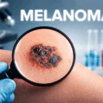 Representative image of a melanoma lesion under examination. Moderna and Merck’s 5-year data show their personalized mRNA cancer vaccine may significantly reduce recurrence in high-risk cases.