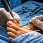 Ossio Inc. expands bio integrative fixation into bunion surgery with metal free MIA system