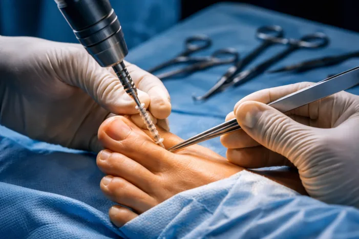 Can OSSIOfiber metal free bunion fixation redefine minimally invasive hallux valgus surgery?