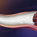 BD secures EU CE Mark for Revello vascular covered stent as iliac artery treatment competition intensifies