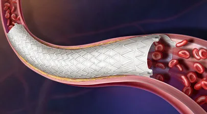 CE Mark clearance for BD Revello stent highlights growing competition in endovascular PAD therapies