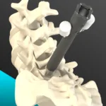 Allevion Medical Vantage gets 510(k) clearance, but adoption will depend on evidence, workflow fit, and reimbursement clarity