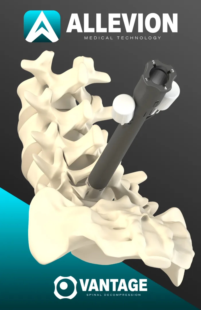 Can Allevion Medical’s Vantage change spinal stenosis workflows by combining disposable access, illumination, and bone resection tools?