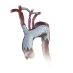 Endospan wins FDA approval for NEXUS aortic arch stent graft system, opening a new chapter in complex arch repair