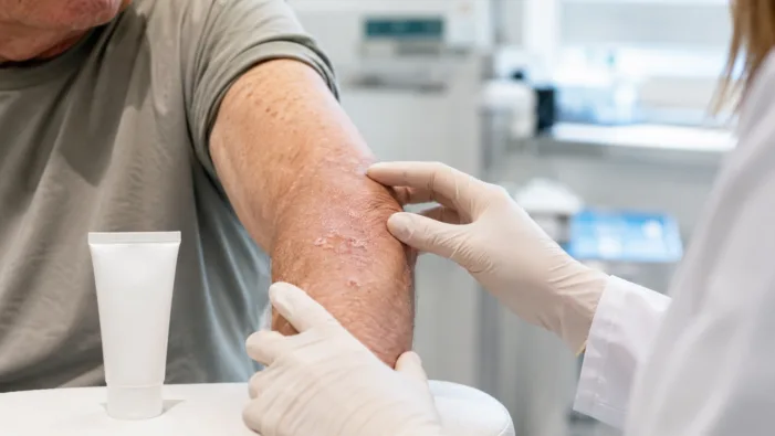 Representative image showing a clinical skin examination for actinic keratosis, as Rubedo Life Sciences reports early RLS-1496 data suggesting lesion reduction with minimal irritation in a Phase 1b/2a dermatology study. Rubedo takes cellular rejuvenation into actinic keratosis with early RLS-1496 results