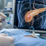 Representative image of a microneedle catheter concept for targeted intratumoral drug delivery in pancreatic cancer, reflecting Vector Science & Therapeutics’ early-stage research into localized oncology treatment platforms.
