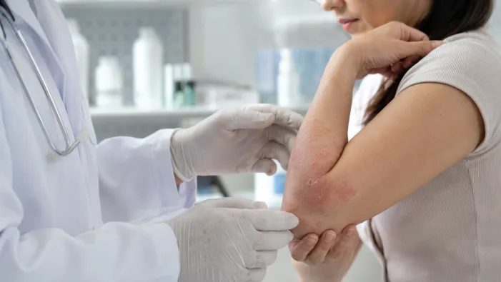 Representative image: A dermatologist examines an eczema flare, reflecting how EBGLYSS and other atopic dermatitis biologics are shifting the treatment conversation toward fewer injections, longer disease control, and lower patient burden. How EBGLYSS shows the eczema market is moving from breakthrough launches to lifecycle strategy