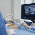 A clinician performs an ultrasound-guided breast cryoablation procedure as IceCure Medical expands ProSense installations for minimally invasive treatment of selected low-risk breast cancer patients. Representative image.