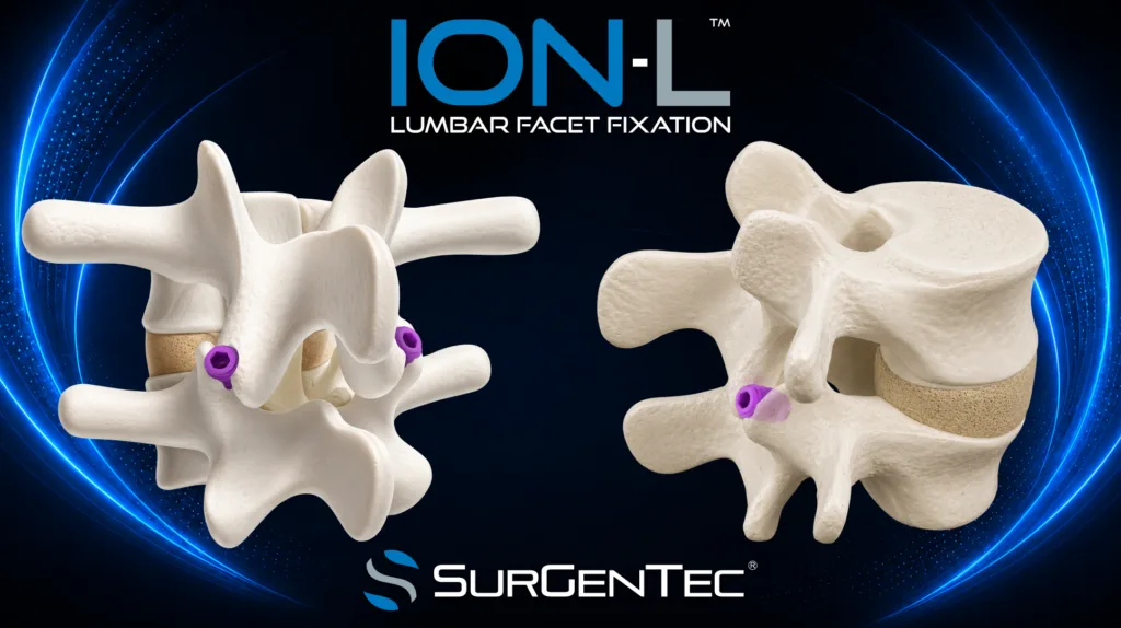 SurGenTec ION-L enters lumbar spine market as surgeons weigh minimally invasive fusion promise