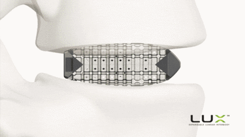 Xenix Medical’s Lux system targets a key pain point in lumbar fusion surgery