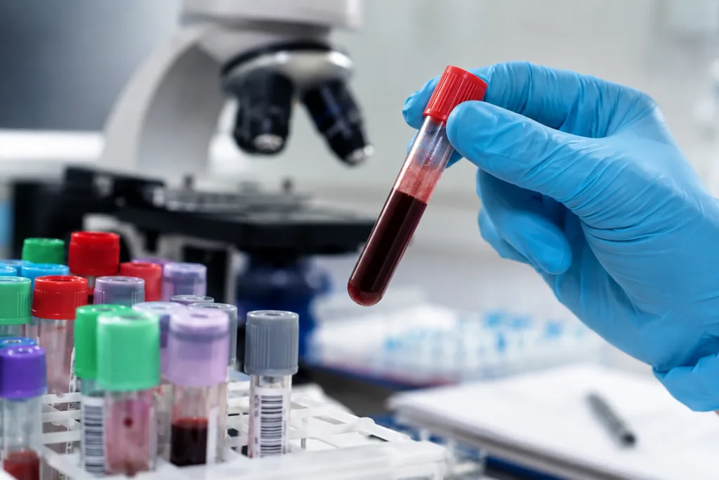 Representative image of blood testing in a clinical laboratory, reflecting coverage of Agios Pharmaceuticals’ mitapivat Phase 3 RISE UP data and the evolving sickle cell disease treatment debate.