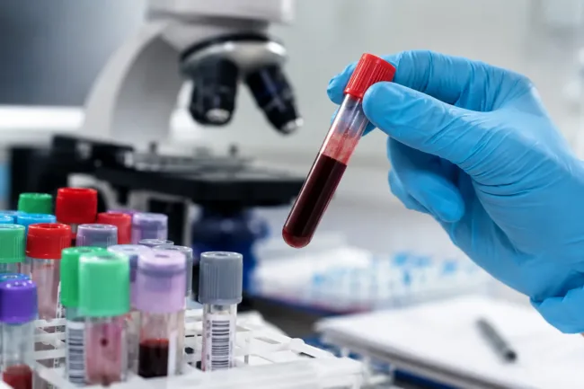 Representative image of blood testing in a clinical laboratory, reflecting coverage of Agios Pharmaceuticals’ mitapivat Phase 3 RISE UP data and the evolving sickle cell disease treatment debate.