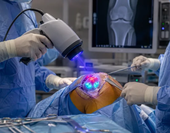 MolecuLightDX fluorescence imaging is being evaluated during revision knee surgery to help surgeons detect residual bacterial signals after standard debridement, although larger controlled studies are needed to confirm clinical benefits. Representative image.