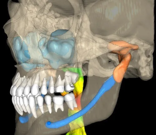Velmeni’s FDA-cleared V4D 3D software brings artificial intelligence-assisted segmentation, visualization and analysis to dental cone-beam computed tomography workflows. Representative image.