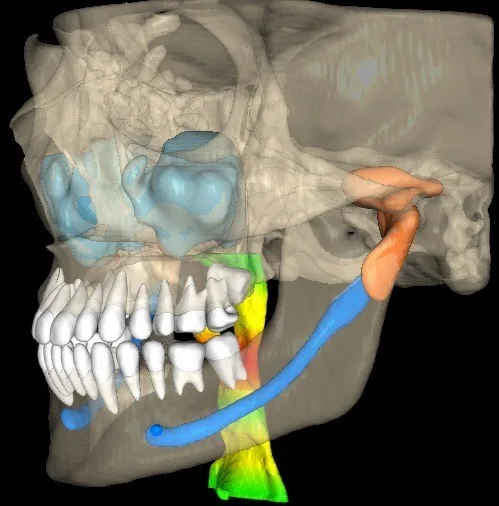 Velmeni’s FDA-cleared V4D 3D software brings artificial intelligence-assisted segmentation, visualization and analysis to dental cone-beam computed tomography workflows. Representative image.