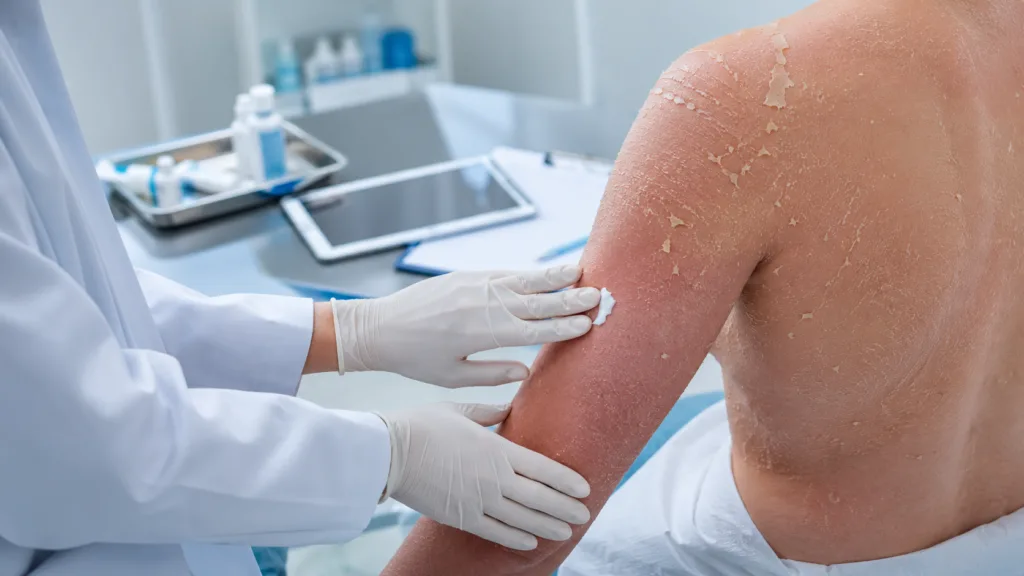 Quoin Pharmaceuticals advances QRX003 toward a Phase 2 trial in generalized inflammatory peeling skin syndrome after receiving U.S. Food and Drug Administration clearance for its investigational new drug application. Representative image.