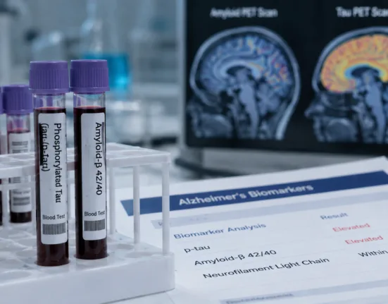 Alzheimer’s blood tests measuring phosphorylated tau and amyloid-related biomarkers can detect Alzheimer’s-associated brain pathology with high accuracy, potentially reshaping diagnostic pathways while raising an important distinction between biomarker detection, population screening and a complete dementia diagnosis. Representative image.
