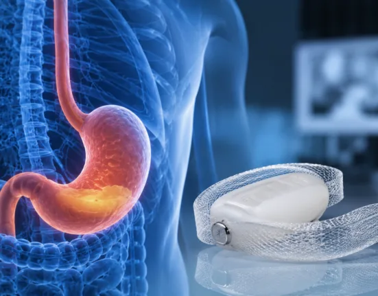 FDA Premarket Approval gives Implantica a US commercialization pathway for RefluxStop, a gastroesophageal reflux disease implant backed by long-term clinical evidence and designed to avoid encircling the esophagus. Representative image.