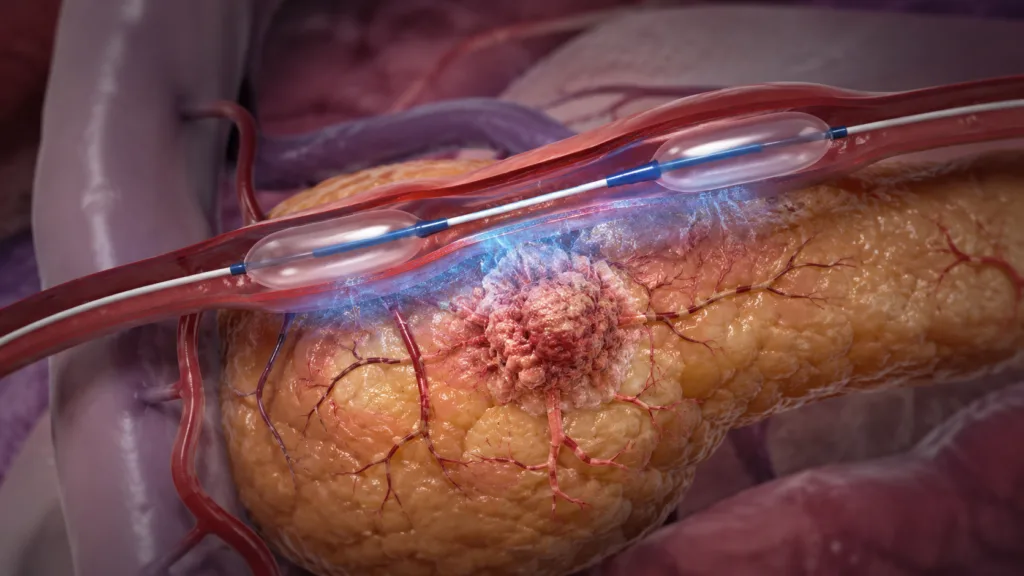 Representative image: Targeted pancreatic cancer drug delivery using a catheter-based arterial approach, illustrating RenovoRx’s TAMP platform as new TIGeR-PaC data show about 51% targeted gemcitabine extraction near the treatment site.