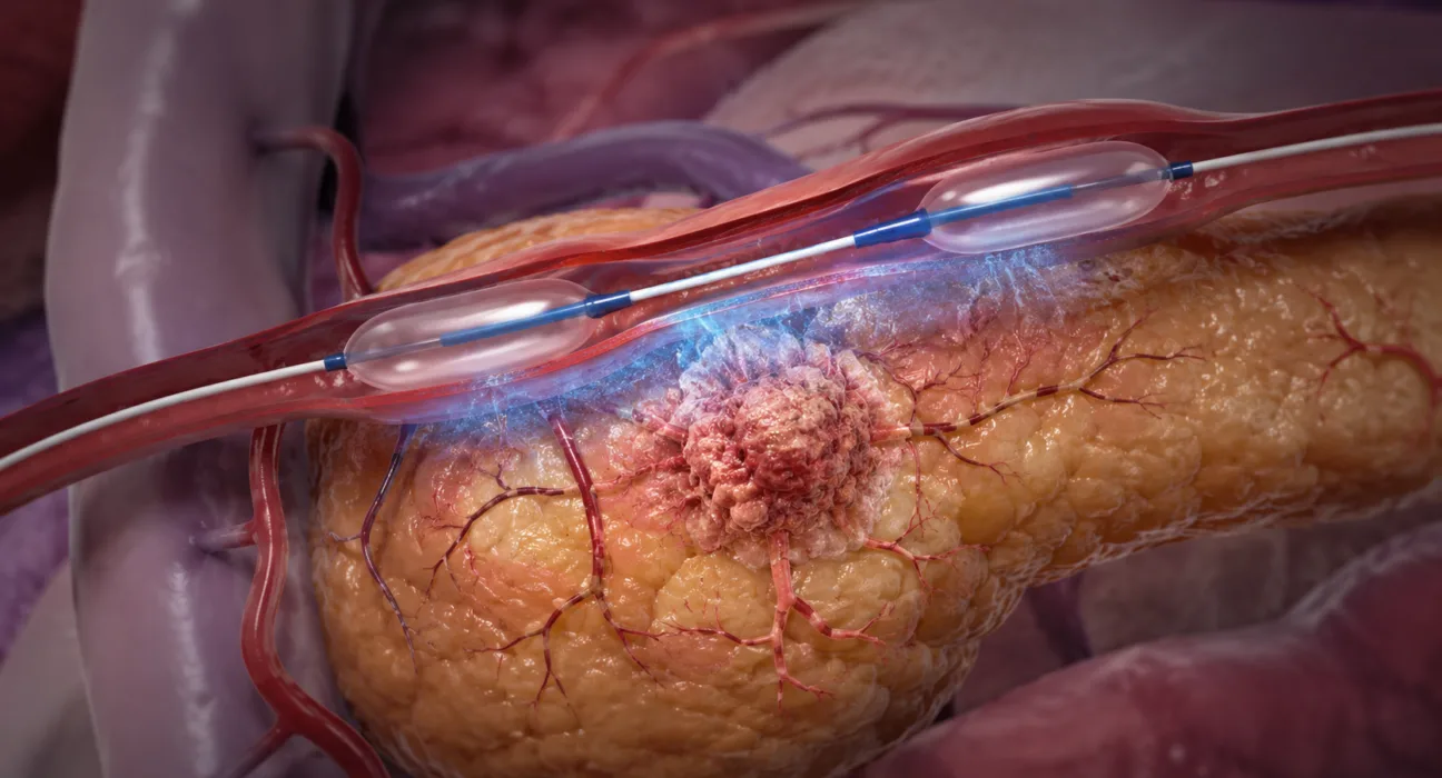 Representative image: Targeted pancreatic cancer drug delivery using a catheter-based arterial approach, illustrating RenovoRx’s TAMP platform as new TIGeR-PaC data show about 51% targeted gemcitabine extraction near the treatment site.