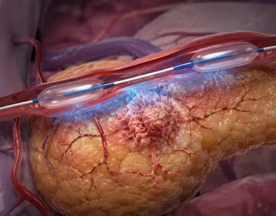 Representative image: Targeted pancreatic cancer drug delivery using a catheter-based arterial approach, illustrating RenovoRx’s TAMP platform as new TIGeR-PaC data show about 51% targeted gemcitabine extraction near the treatment site.