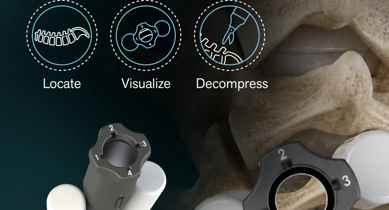 SurGenTec expands minimally invasive spine surgery portfolio with disposable Vantage system